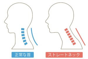ストレートネック